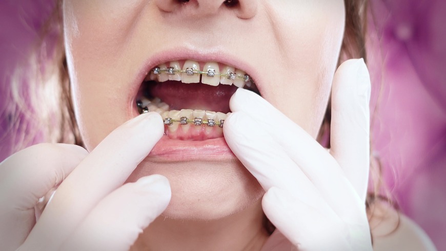 ASMR: upgraded braces with chain-link rubber bands and nitrile gloves (Arya Grander)  - clip coverforeground