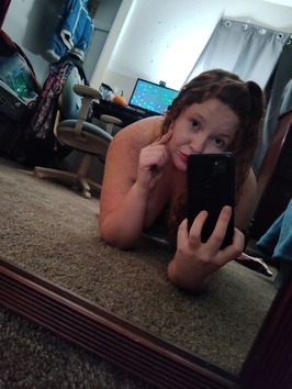 freckles